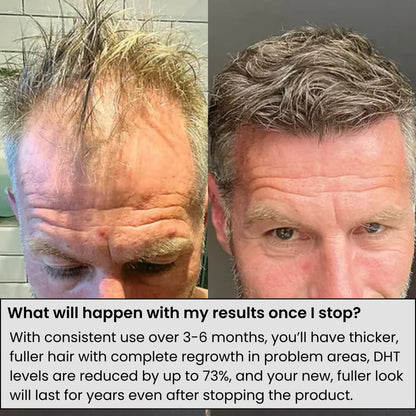 Advanced Micro-Infusion Hair Restoration System