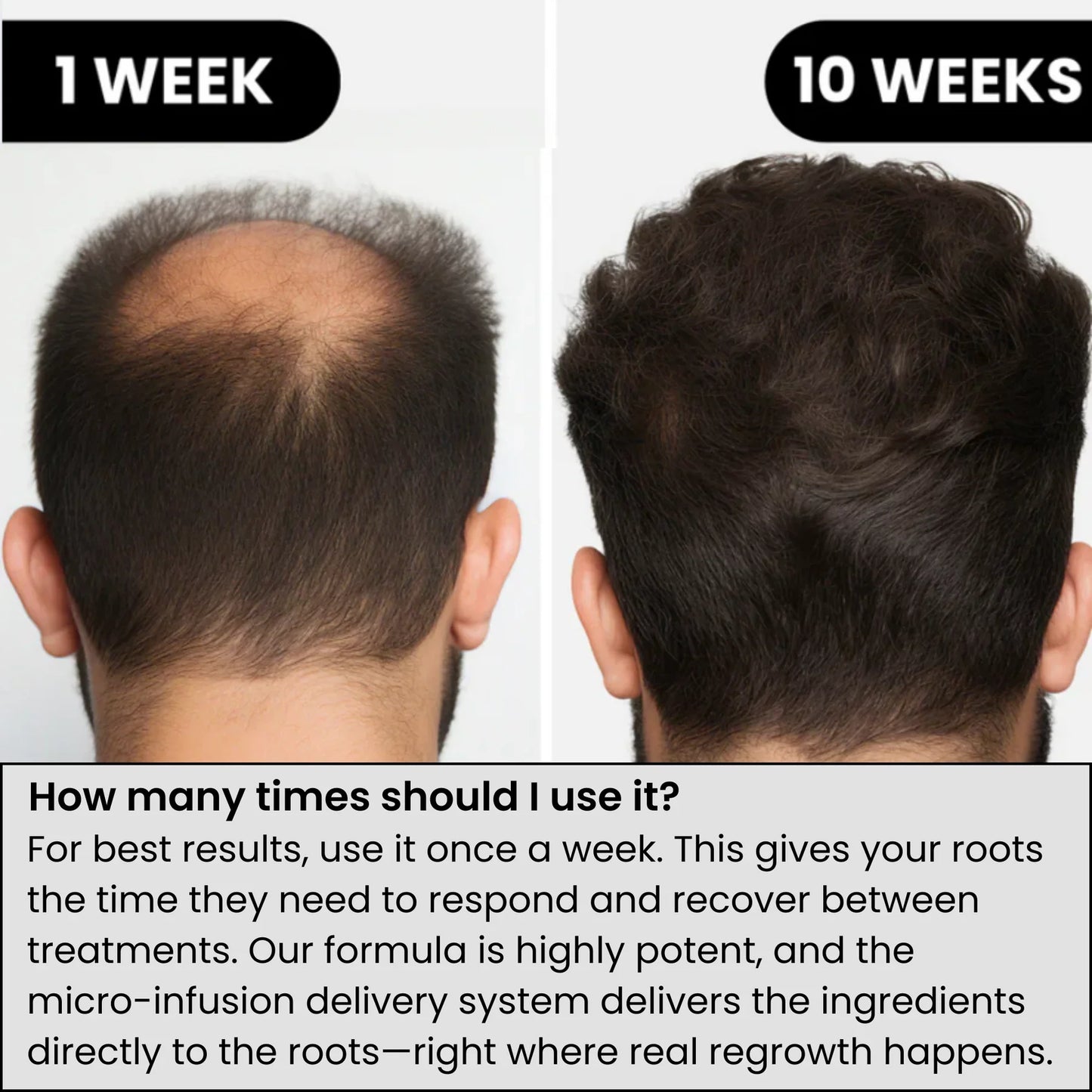 Advanced Micro-Infusion Hair Restoration System